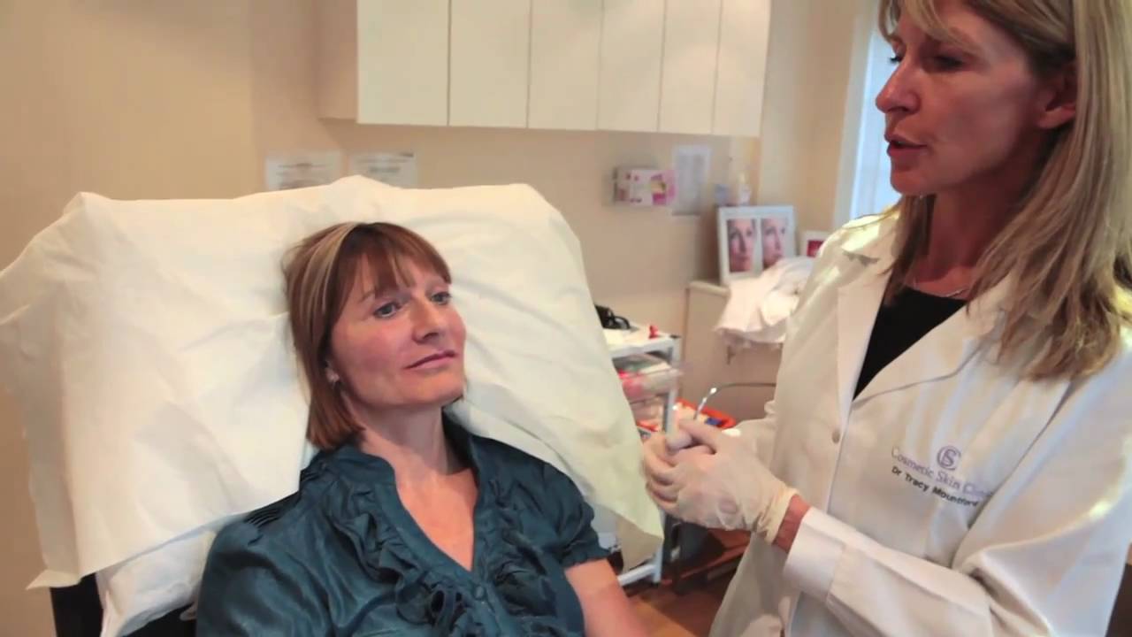 Y Lift Facial Fillers - Procedure Demonstration