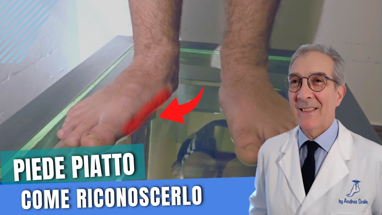 Come capire se si ha il piede piatto  | Caratteristiche del piede piatto | Dott. Andrea Scala