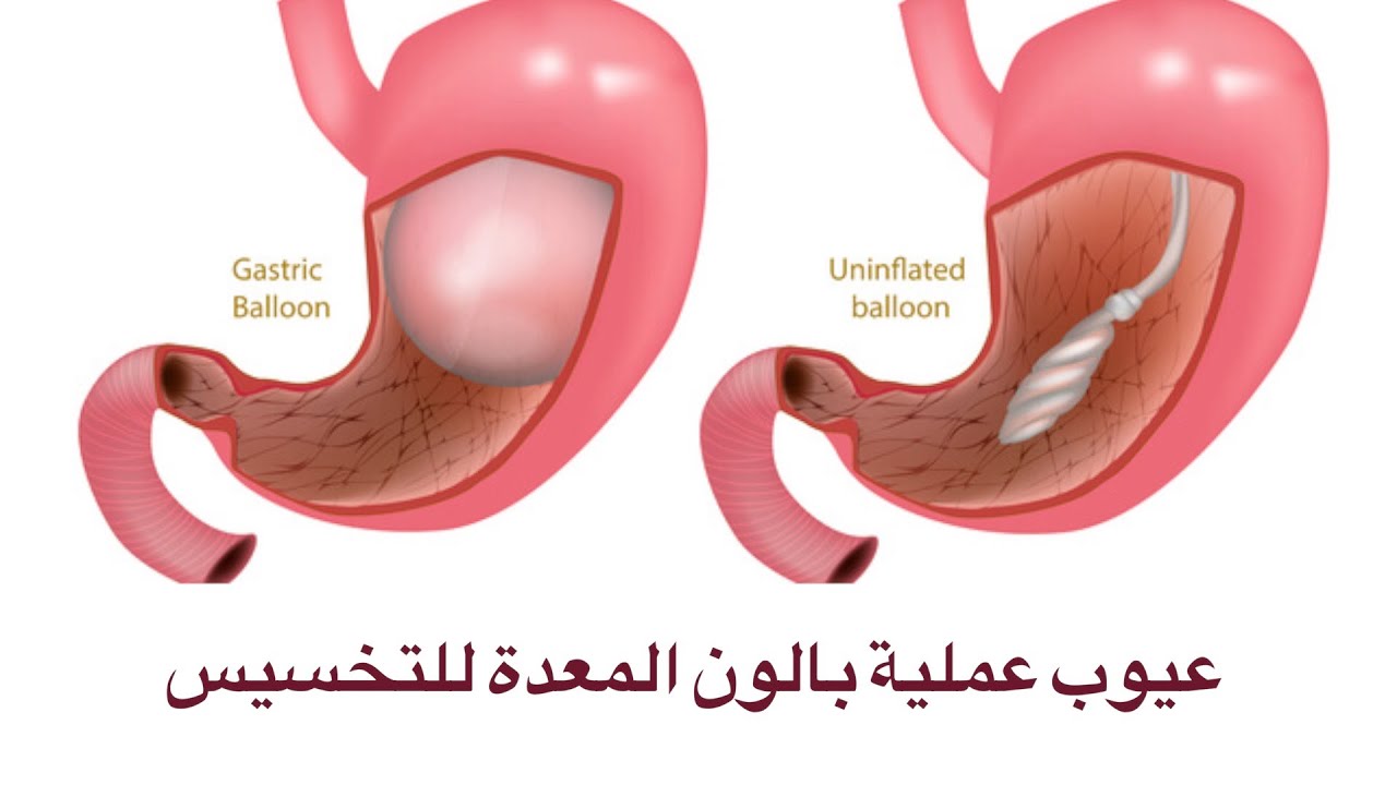 مميزات وعيوب بالون المعدة