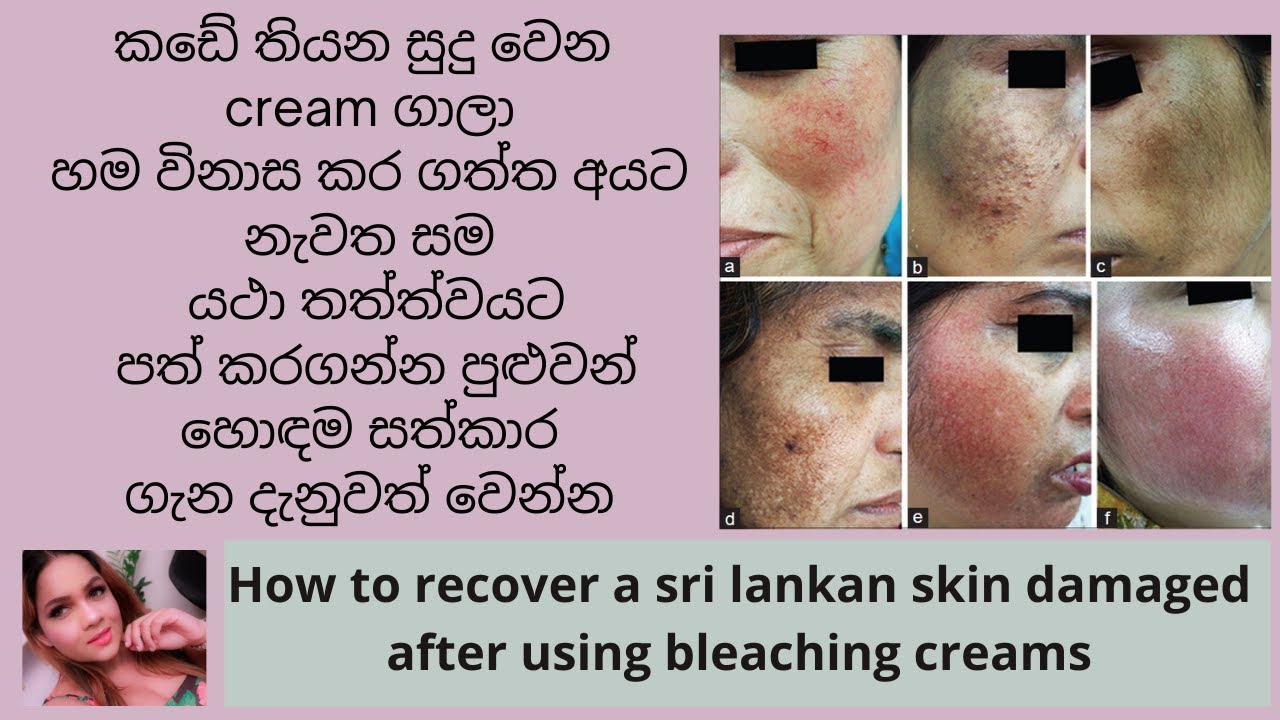 How to recover a sri lankan skin damaged after using bleaching creams in sinhala | pavithra peiris