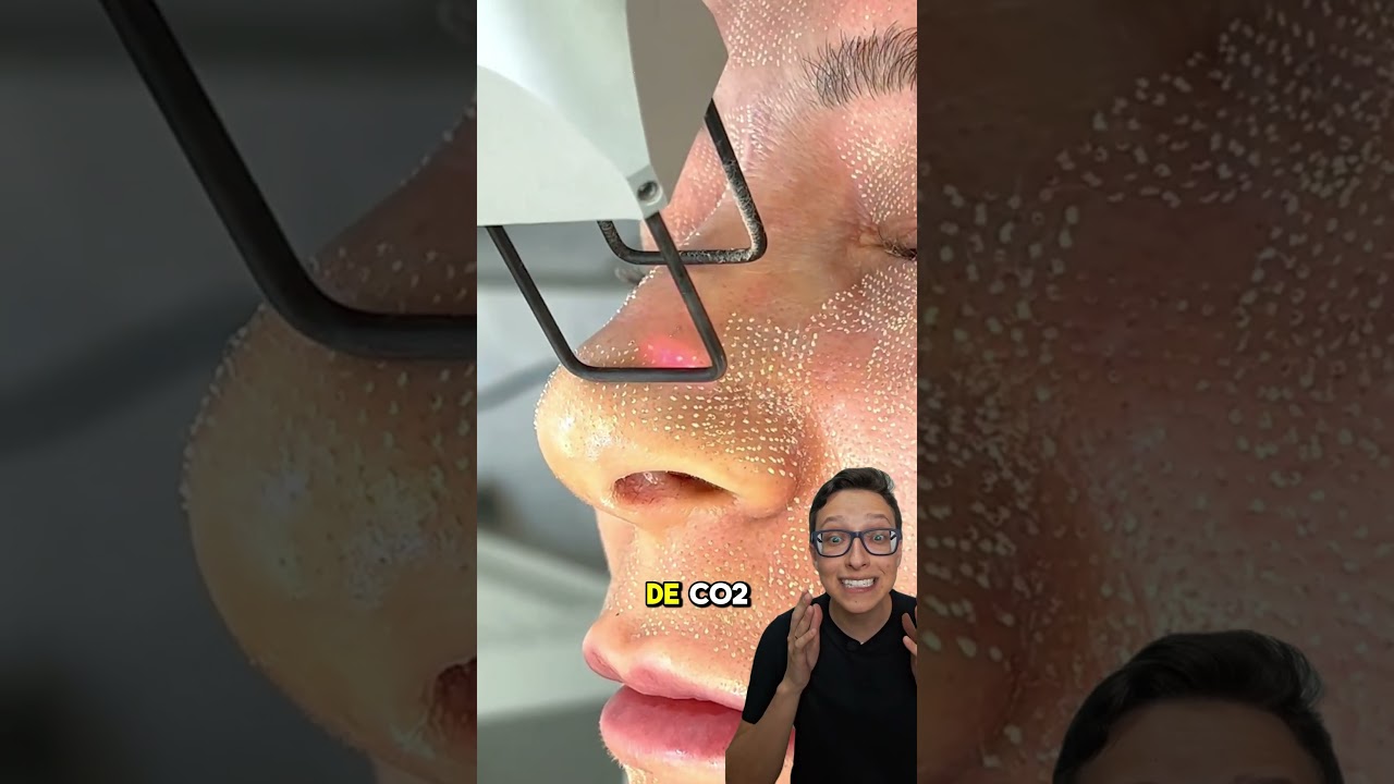 Laser de CO2 Antes e Depois 😱 #medicina #medico #enfermagem #enfermeiro #enfermeira Peeling a Laser