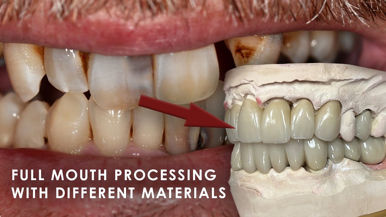 Full Mouth Processing with Different Materials