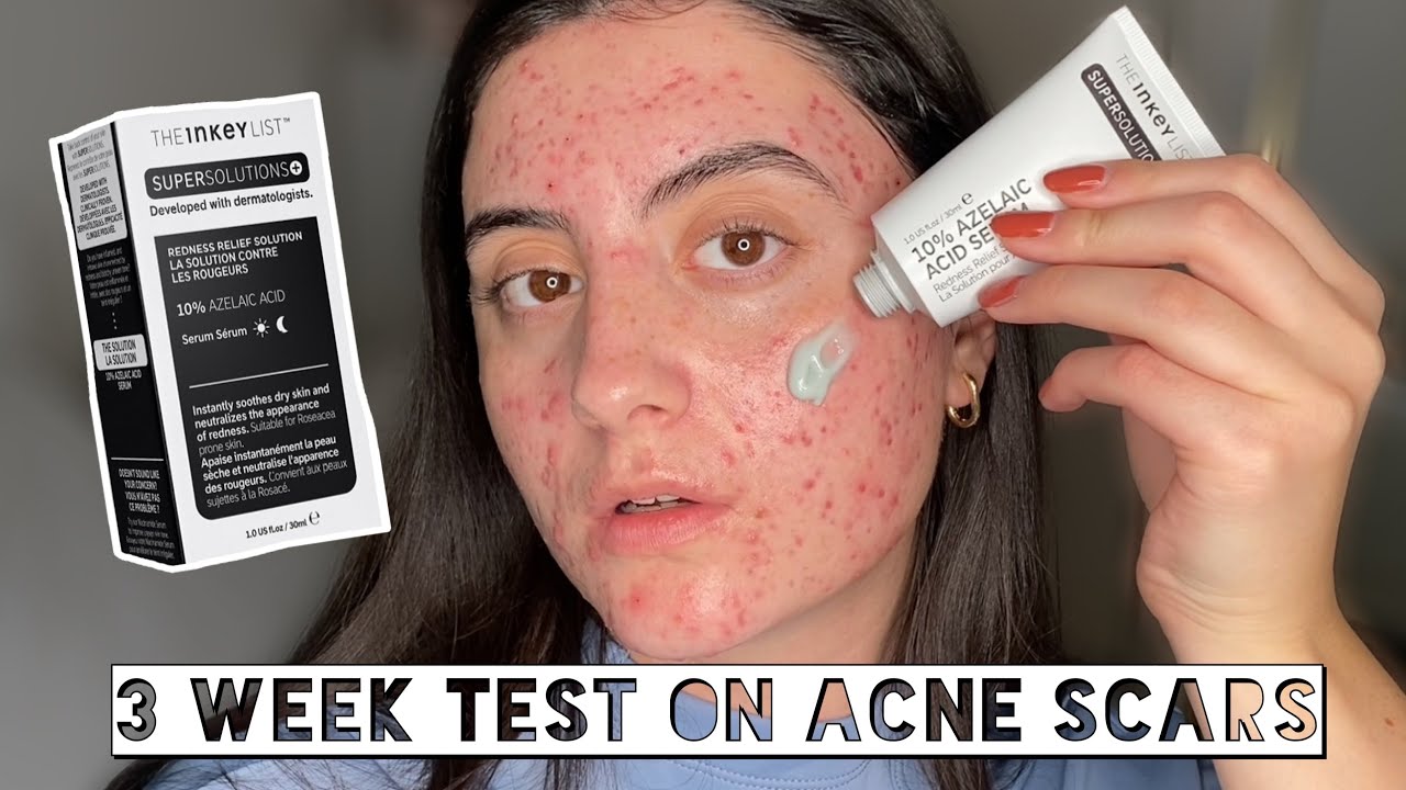 TESTING THE INKEY LIST SUPERSOLUTIONS 10% AZELAIC ACID SERUM ON DEEP ACNE SCARS FOR 3 WEEKS