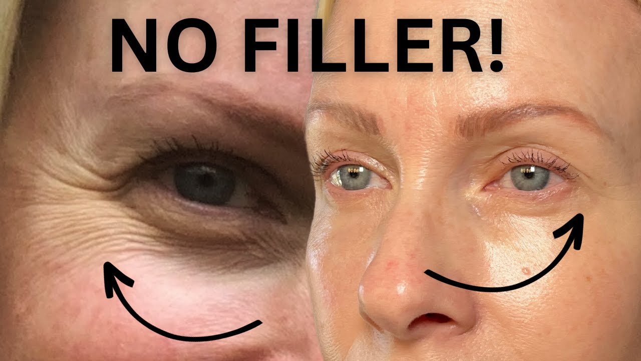 Get rid of EYE WRINKLES | featuring radio frequency by CURRENTBODY