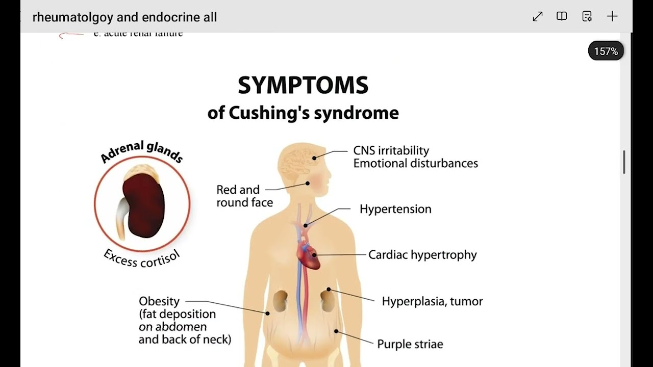 EMLE Endocrine Review | مراجعة أهم أسئلة الاندوكراين- مزاولة المهنة