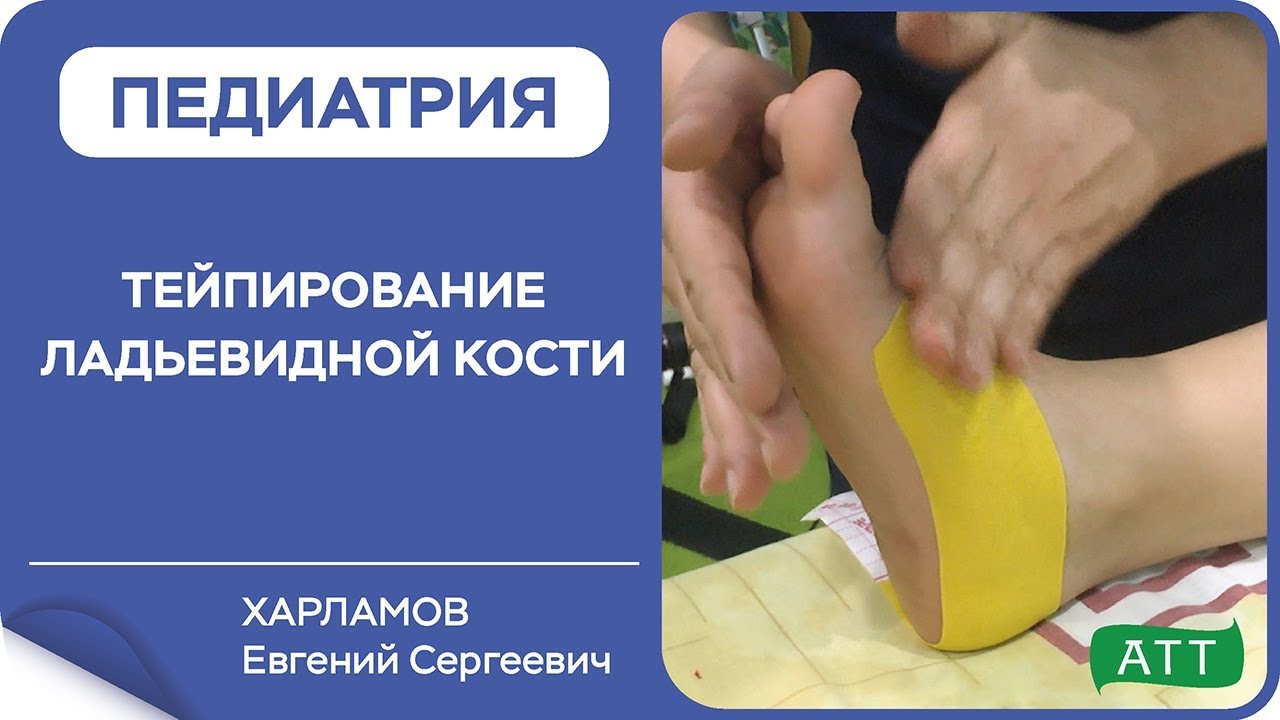Тейпирование стопы при плоскостопии  Ладьевидная кость. Ортотейпинг. Харламов Е.С.
