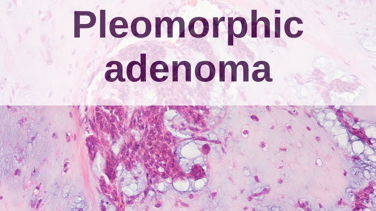 Pleomorphic Adenoma of Salivary Gland