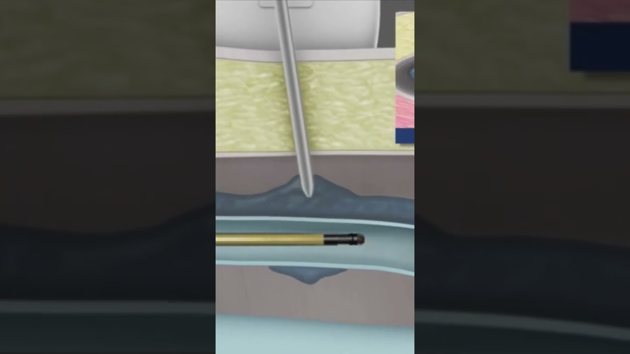 Как работает радиочастотная абляция подкожной вены? Лечение варикозного расширения вен