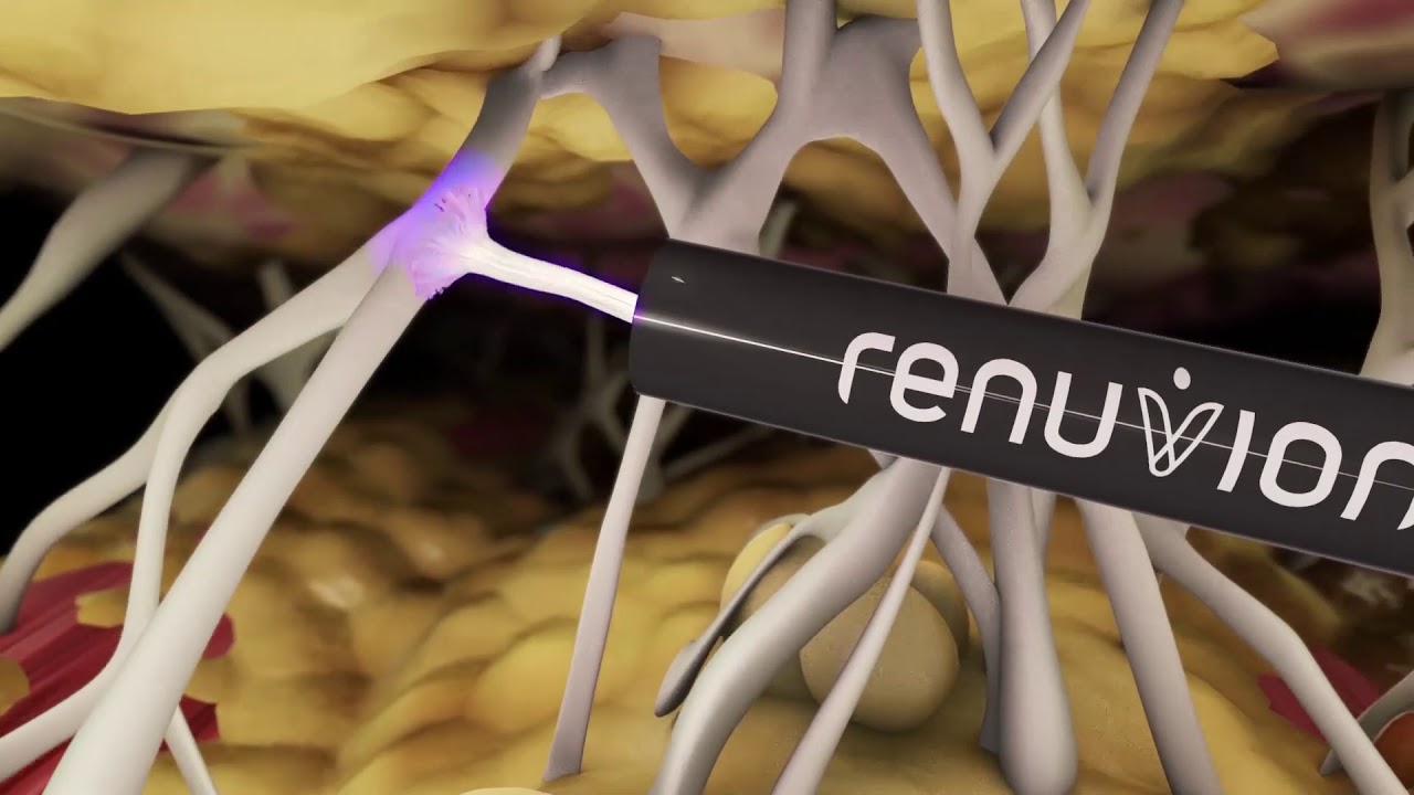 Renuvion - Hautstraffung ohne Narben mit kaltem Plasma