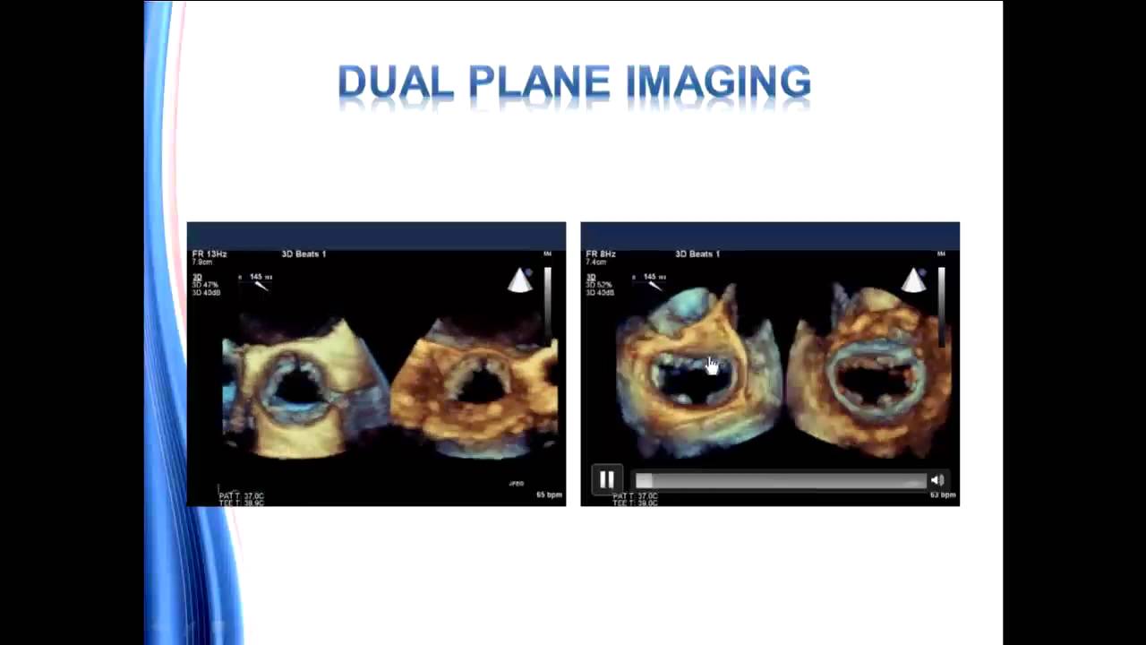 Guidelines for Performing a Comprehensive Transesophageal Echocardiographic Examination