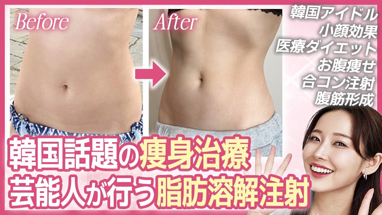 【韓国美容医療体験談】脂肪吸引必要なし！日本語対応OK！韓国アイドルも行う脂肪溶解注射。美容施術、ダウンタイム、効果、ビフォーアフター完全密着！痩せたい、痩身、小顔(幅縮小)、お腹痩せについて完全公開