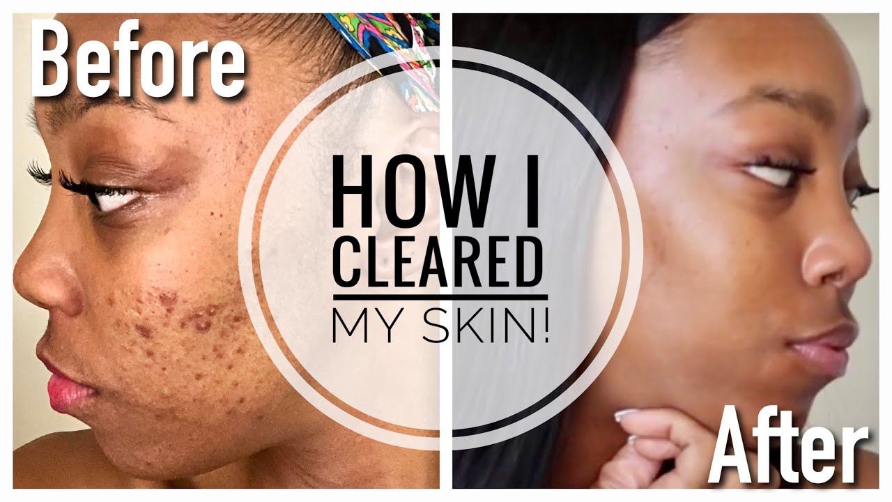 How I Cleared My Skin | My ACCUTANE Journey | Side Effects and Tips | Crystal Nicole