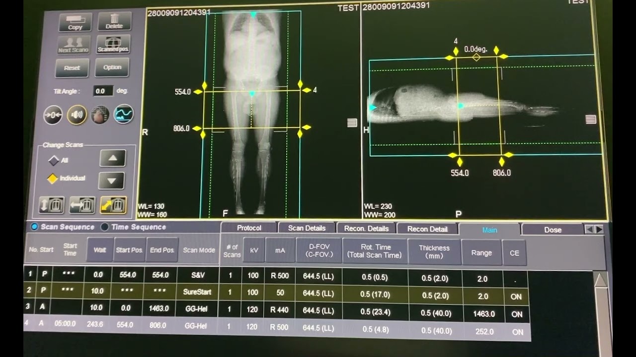 طريقه تصوير الشريان الاورطي وشرايين الطرفين Angiography Both Lower Limb From Aortic Arch To Foot