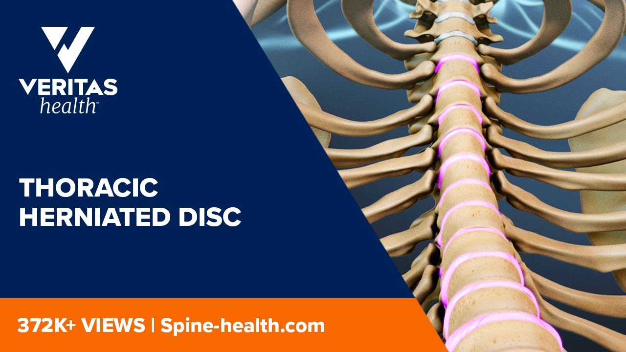 Thoracic Herniated Disc