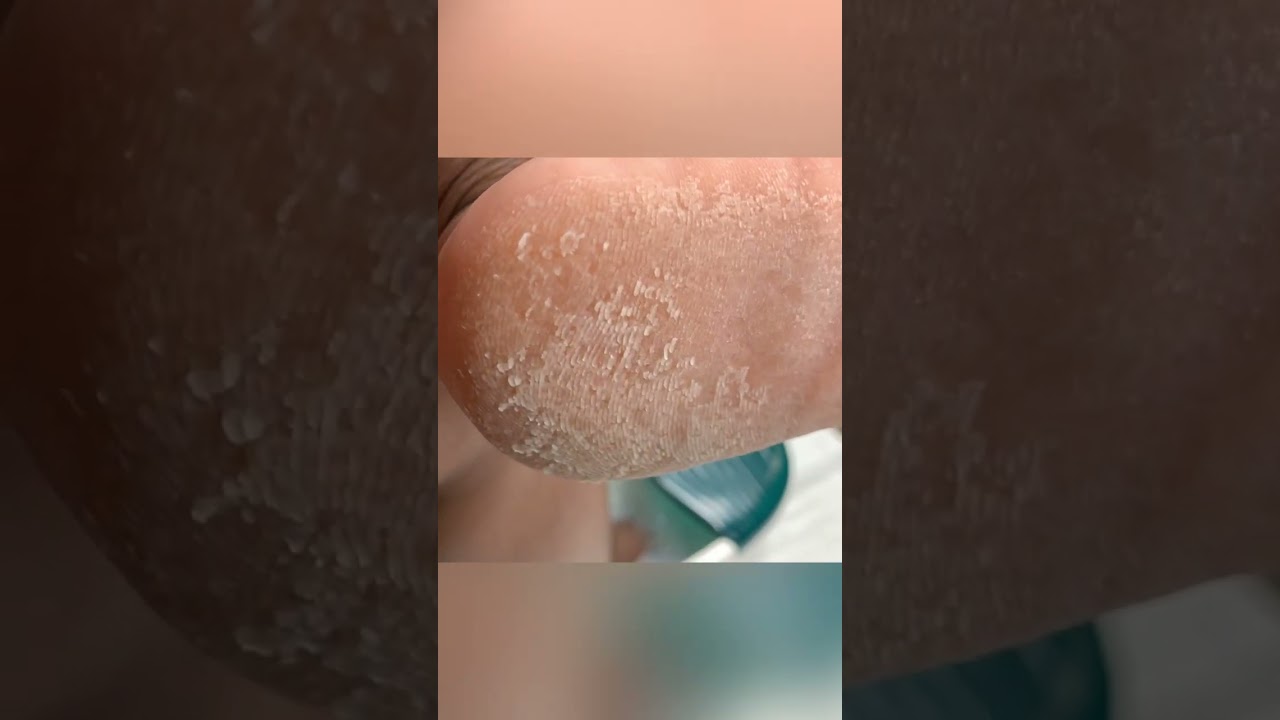 HYDROGEN PEROXIDE TRANSFORMED MY FEET 