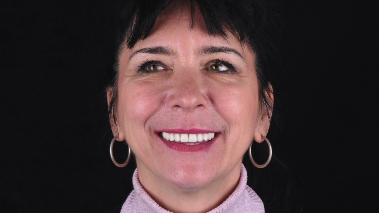 Razlika između proteze na kopčanje i mosta na implantatima.