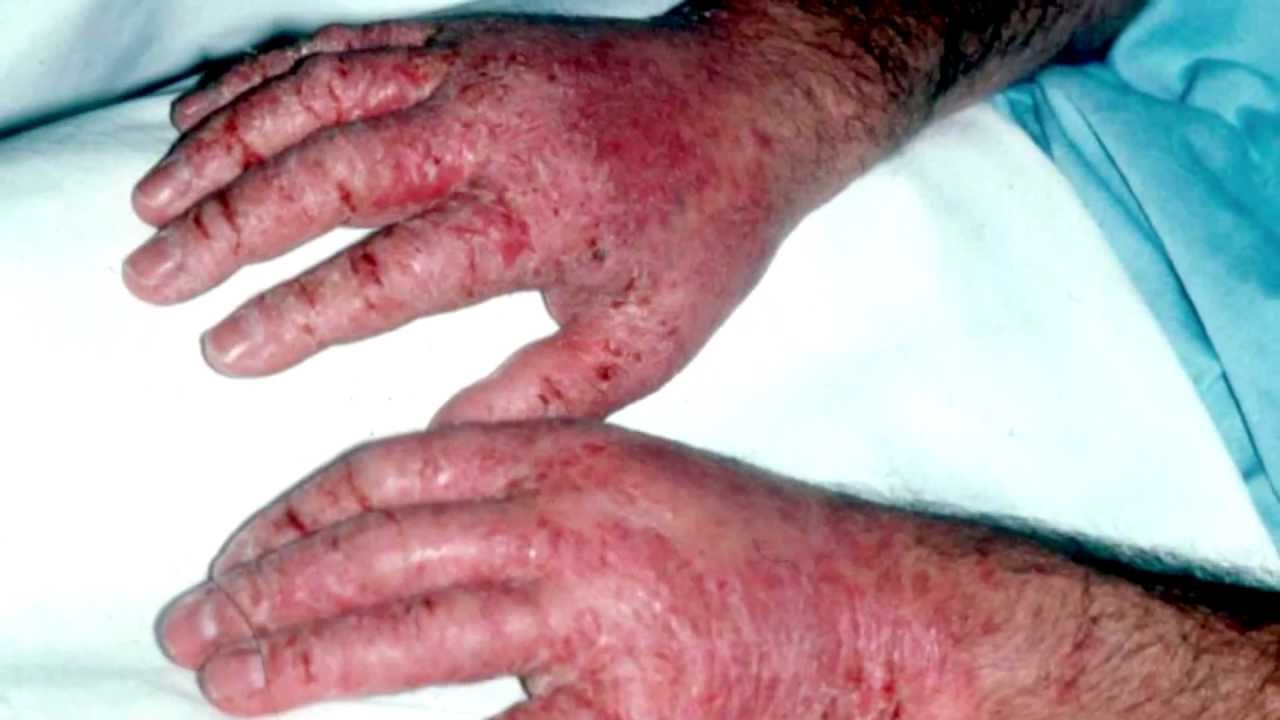 Occupational Skin Disease