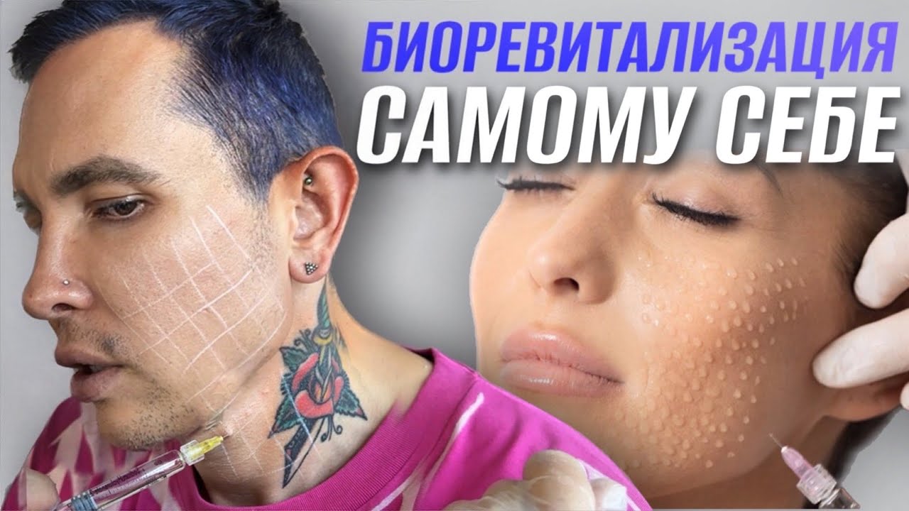 БИОРЕВИТАЛИЗАЦИЯ самому себе | Как я делаю себе инъекции #самсебекосметолог #биоревитализация