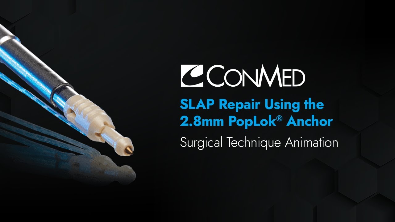 Ремонт SLAP с использованием PopLok® 2,8 мм — анимация CONMED