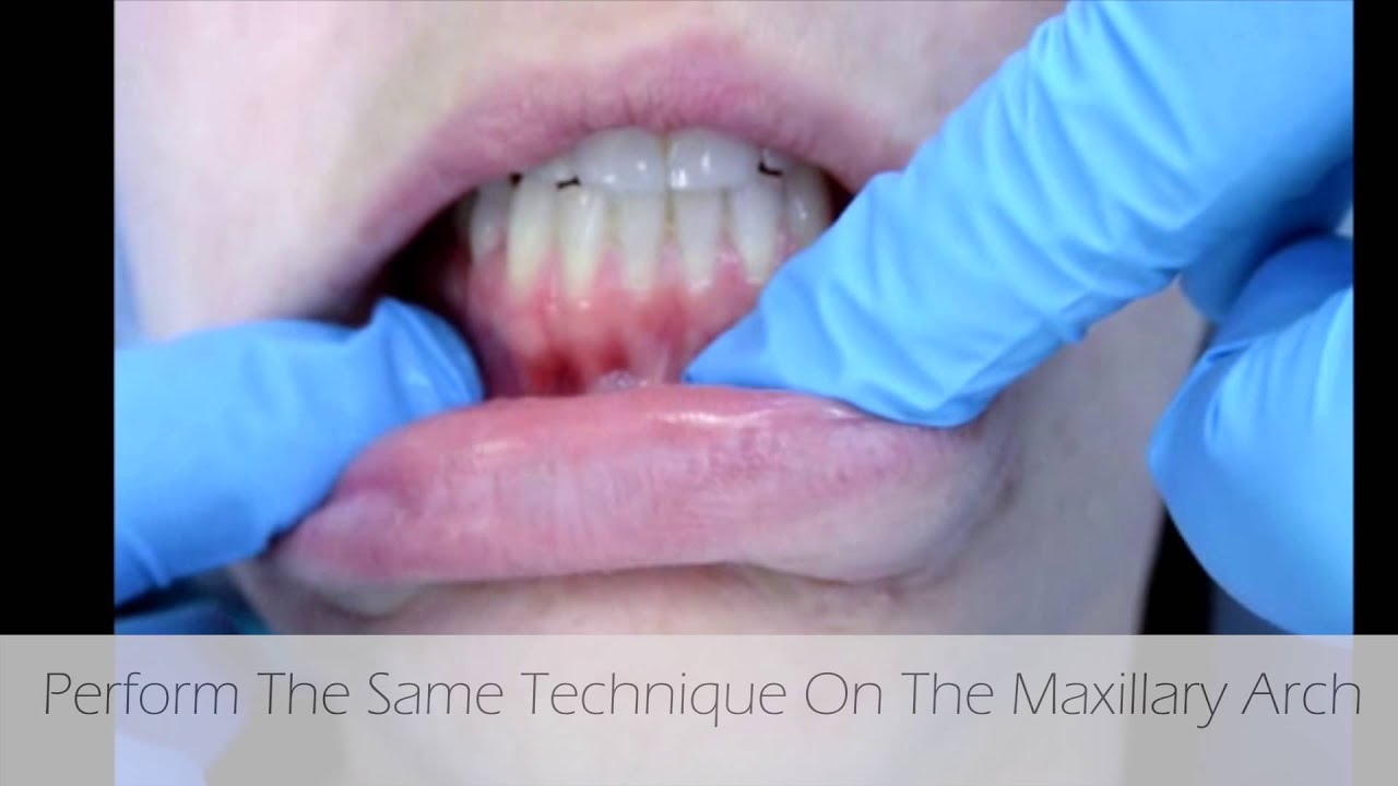 Measuring for Minimally Attached Gingiva