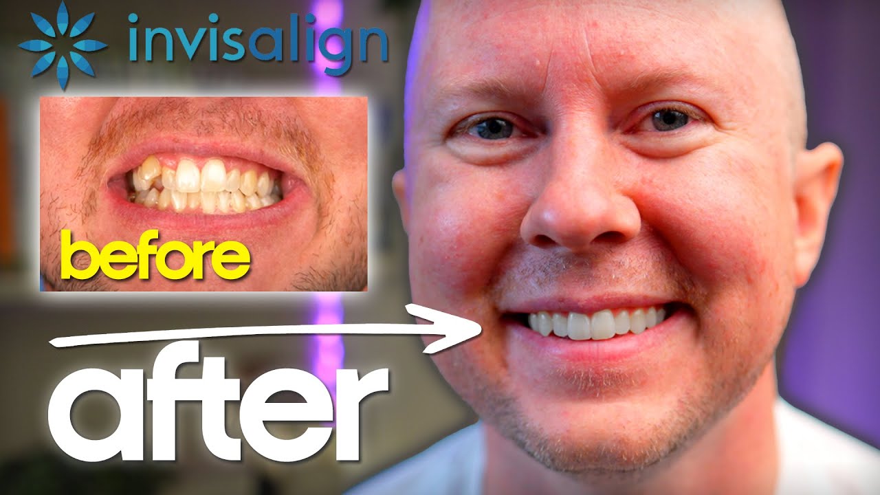 ОБЗОР Invisalign — что вам НЕ говорят о выравнивании зубов!