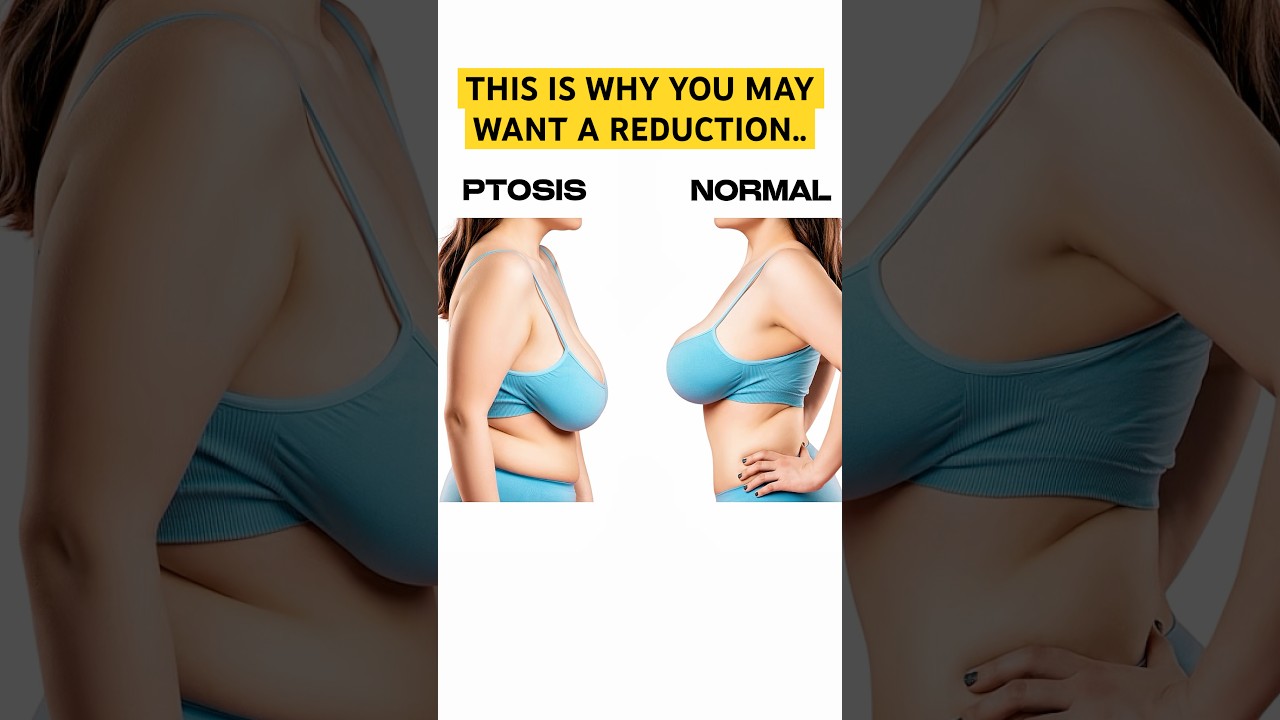 Let&rsquo;s talk about a breast reduction&hellip; #breastreduction #plasticsurgeon
