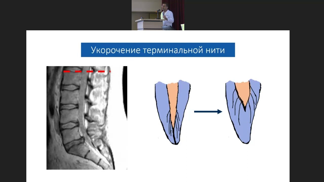 Фиксированный спинной мозг — диагностика и методы лечения!