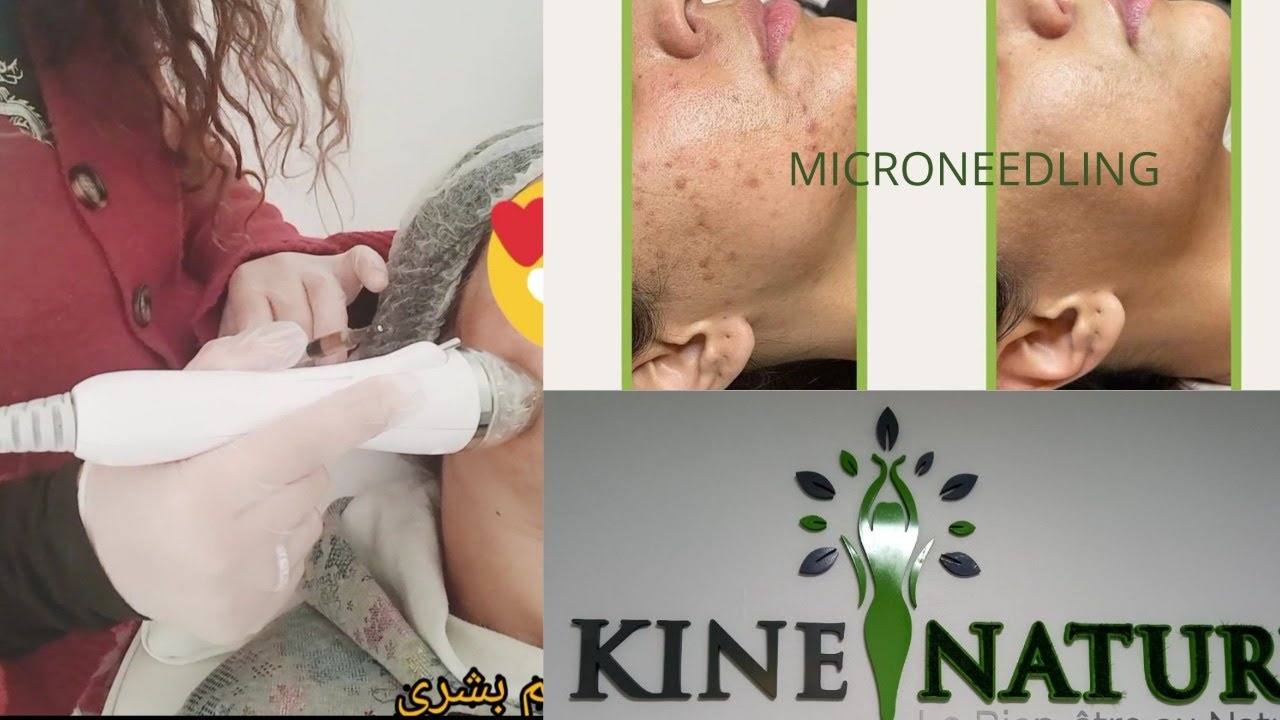 #microneedling_soin_cutané_régénérant_à_micro_aiguilles#تقنية_ _لحل_مشاكل_البشرة#ميكرونيدلينغ