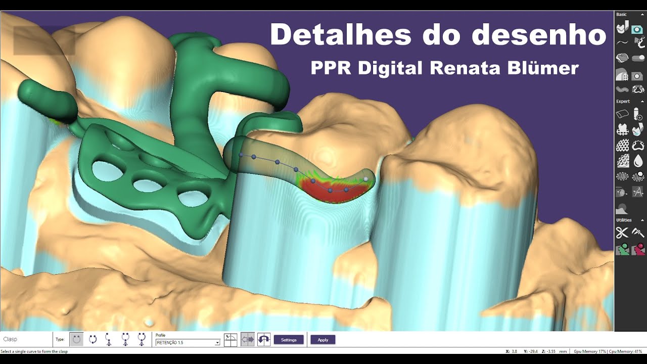 🔍PPR DIGITAL - exocad partialcad -  DETALHES DO DESENHO - GRAMPOS #dicasexocad #dentalppr #exocad