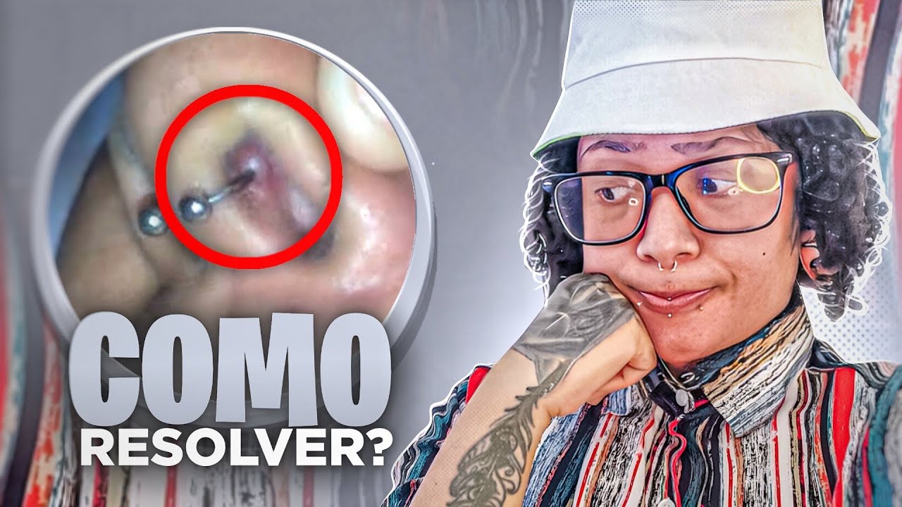 GRANULOMA POR DENTRO DO NARIZ PODE GIRAR A JÓIA ? COMO TRATAR ?