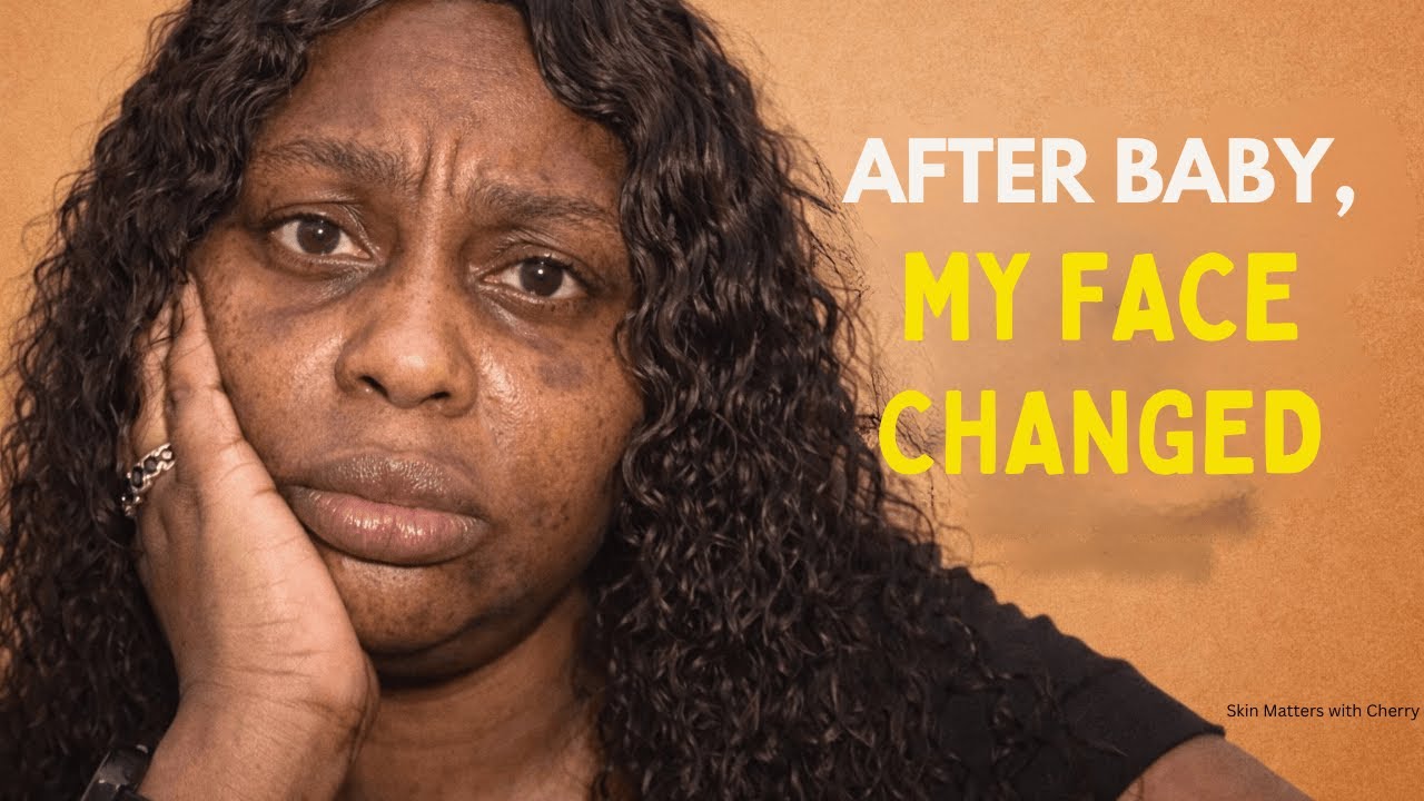 Postpartum Skin Problems Nigerian Doctors Don’t Explain (Dryness, Dark Patches & Breakouts)