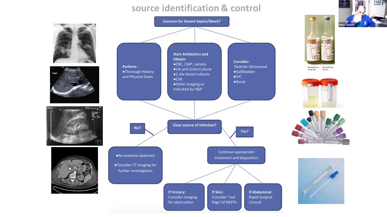 M.Guarino,SIMEU (Soc. It. Medic. Emergenza-Urgenza), webinar Diagnosi e gestione clinica della Sepsi