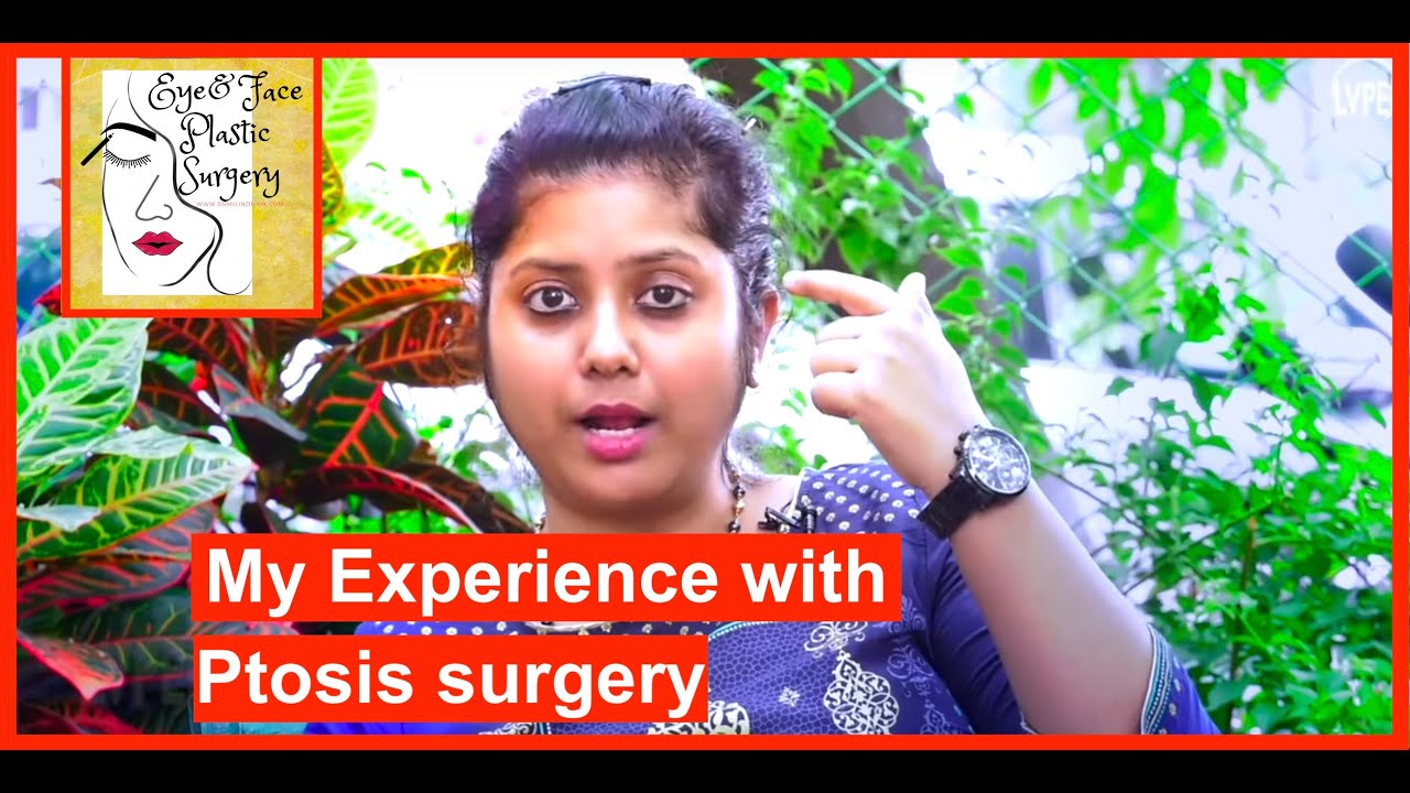 My experience with Eyelid (Ptosis) surgery!
