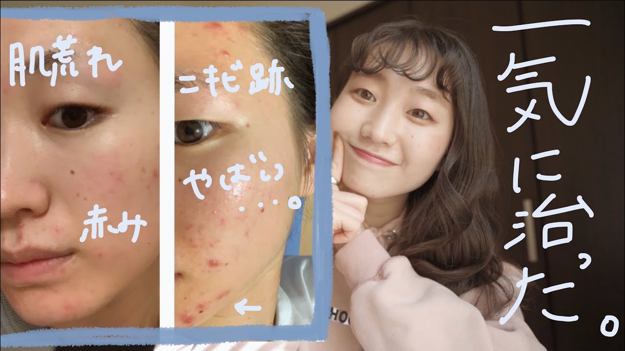 【ニキビ】やばい肌荒れを治した方法