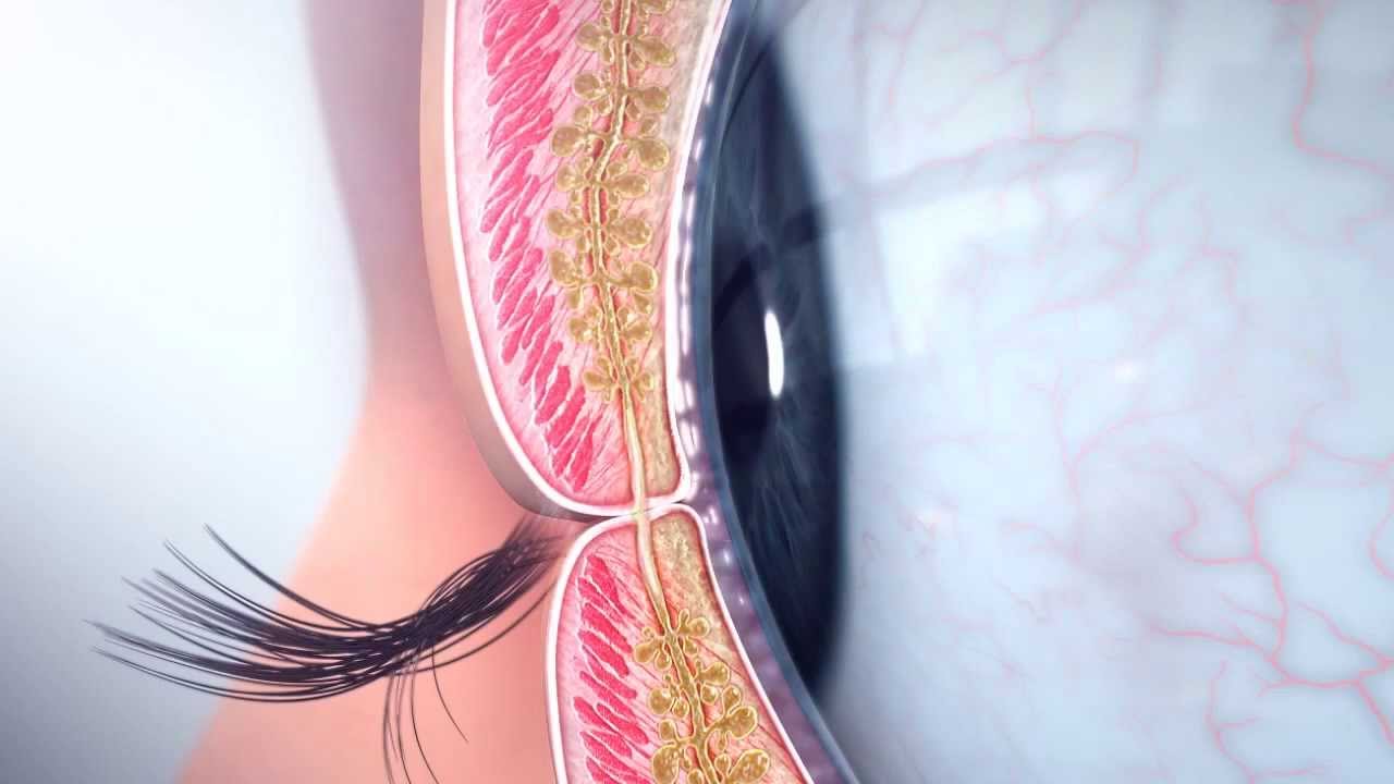 LipiFlow Therapy at the Dry Eye Center of Arizona www.phxdryeye.com
