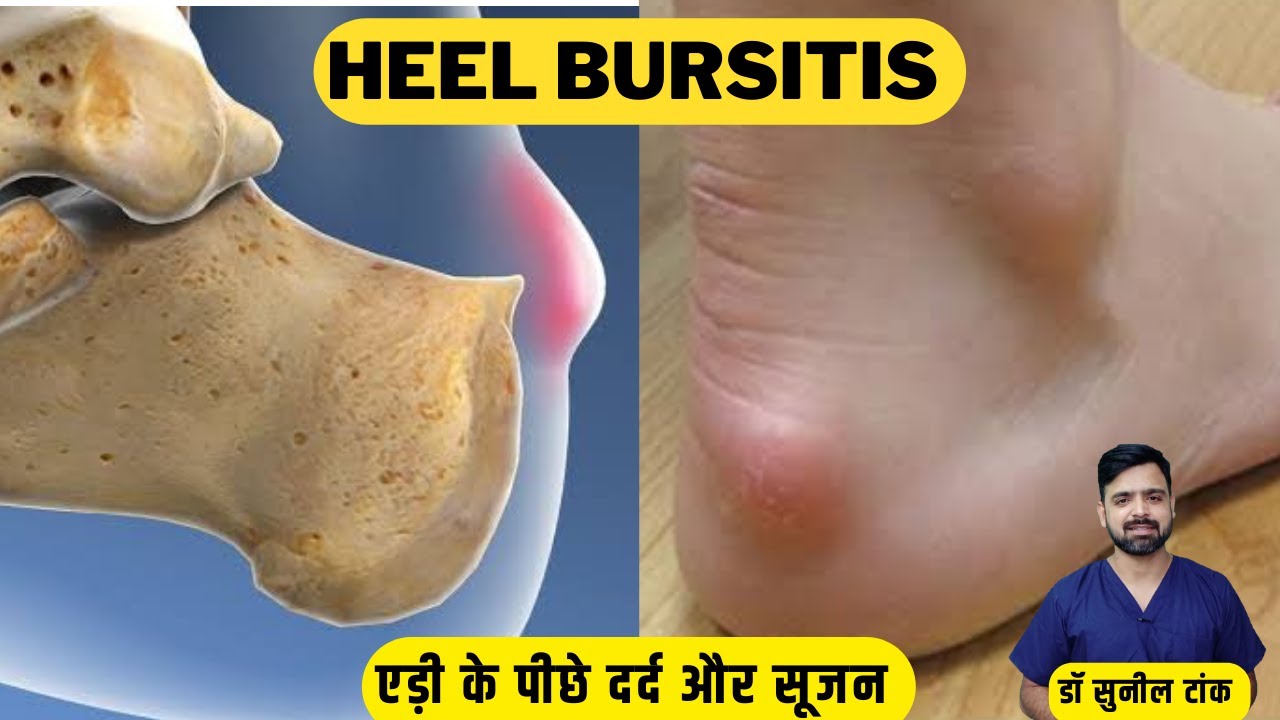 3 Easy Retrocalcaneal Bursitis Exercises for Quick Pain Relief | एडी में दर्द और सूजन का घरेलू इलाज