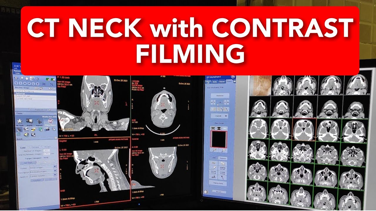 NECK CT scan Filming Protocol.