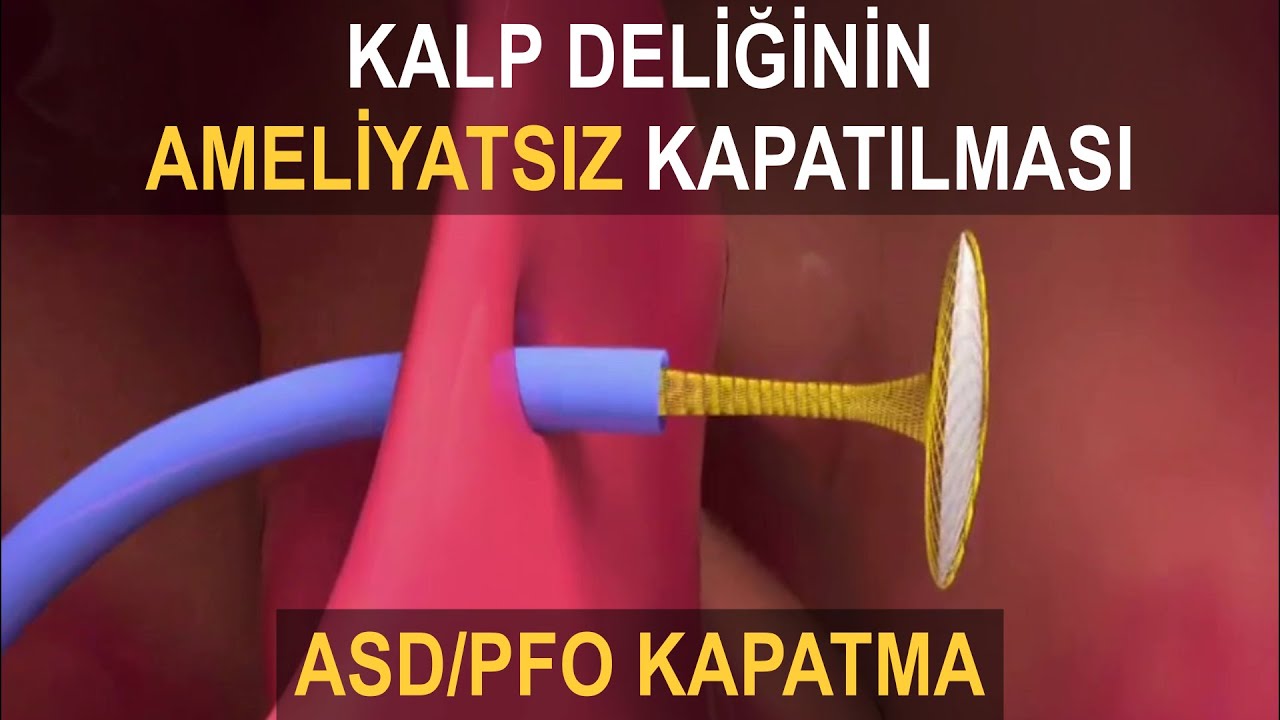 ASD KAPATMA / PFO KAPATMA | Kalp Deliğinin Ameliyatsız Kapatılması