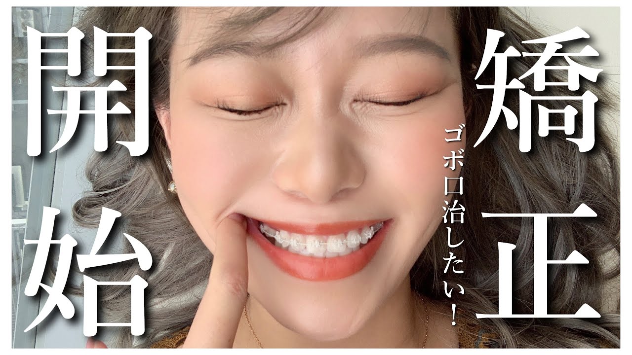 矯正はじめました！費用や理由など話すよ💐ゴボ口治したい【表側ワイヤー矯正】
