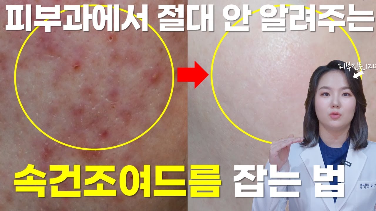 속건조 속당김 건조한데 여드름 나는 이유 관리법 치료법 알려드립니다