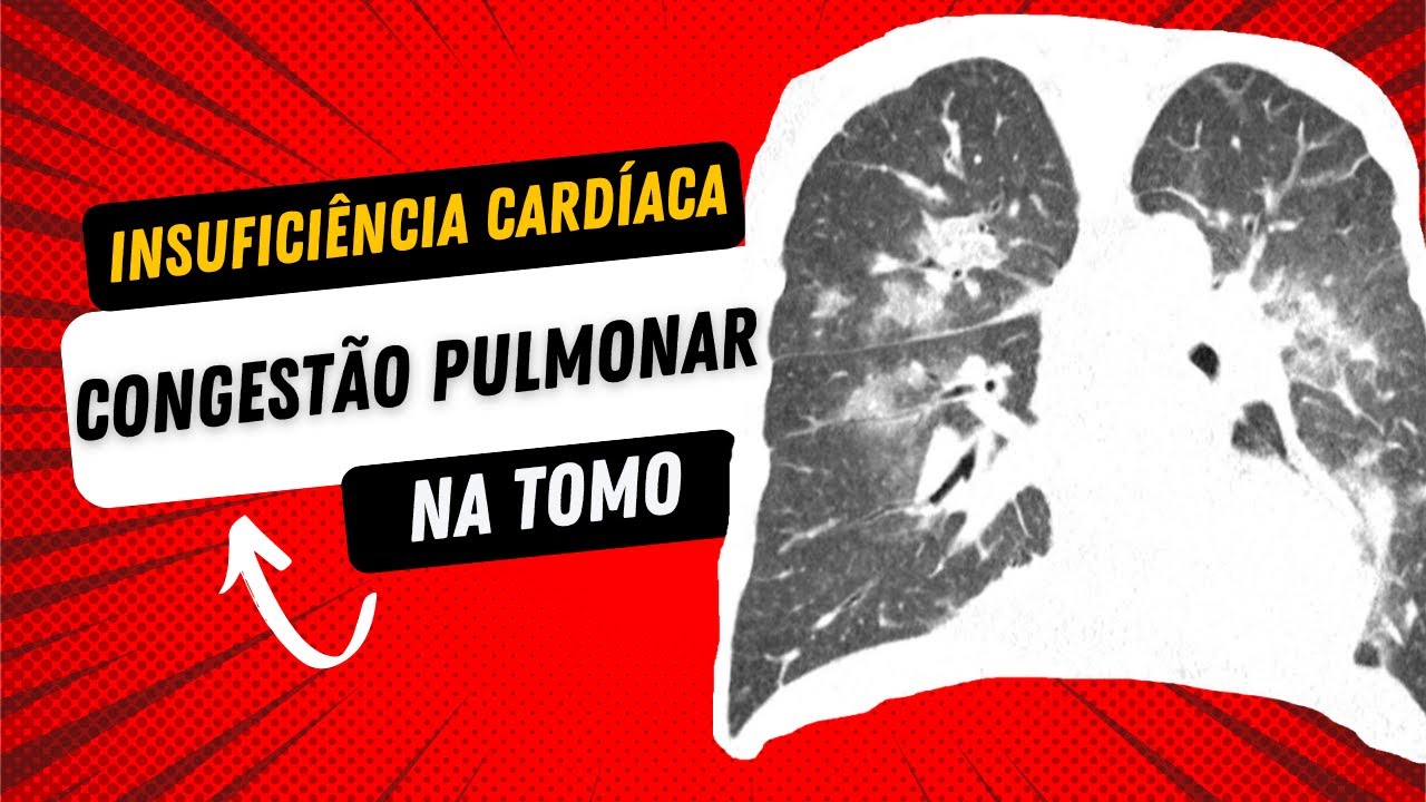 INSUFICIÊNCIA CARDÍACA CONGESTIVA determinando CONGESTÃO PULMONAR na tomografia de tórax