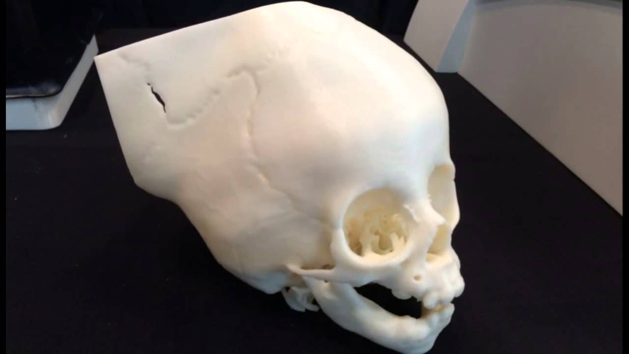 3 D Printed Medical Devices at MD&M East and Atlantic Design & Manufacturing