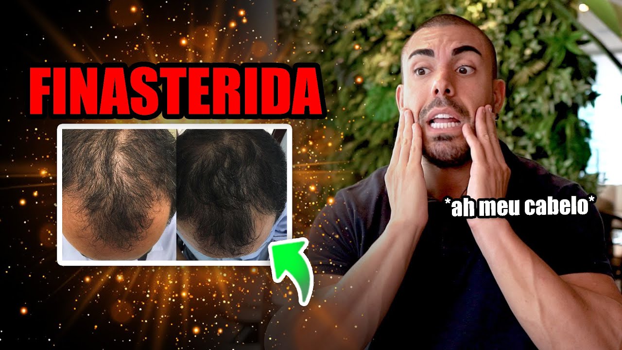 Tudo sobre finasterida *será que brocha?*