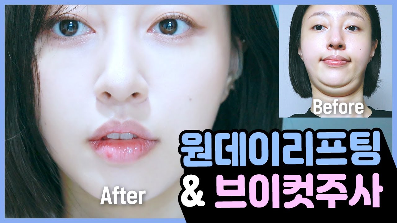 윤곽주사+리프팅 레이저 비포애프터?｜원데이리프팅과 브이컷주사의 시너지효과 [윤곽주사]