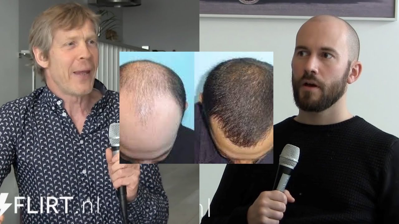 Werkt Finasteride tegen mannelijke kaalheid