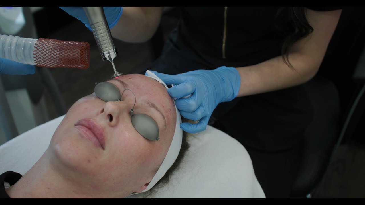 Fotona Laser resurfacing Treatment (No Dialogue)