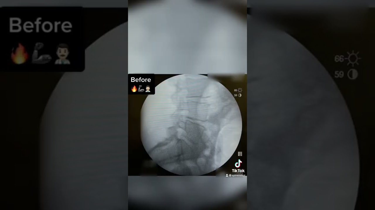 Lumbar decompression and fusion  #back #health #wellness #spine #surgery #education  #health #viral