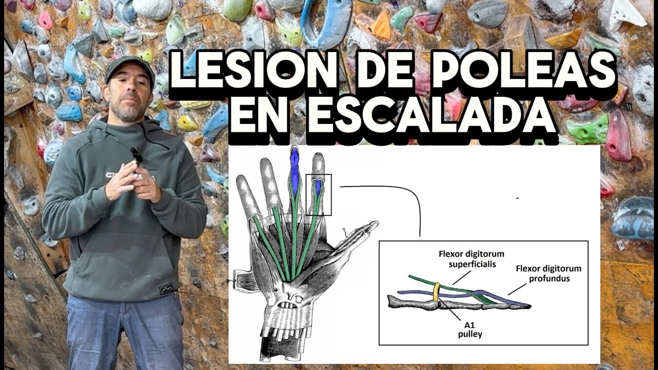 Lesi&oacute;n de poleas en Escalada - una de las principales causas que te impiden escalar