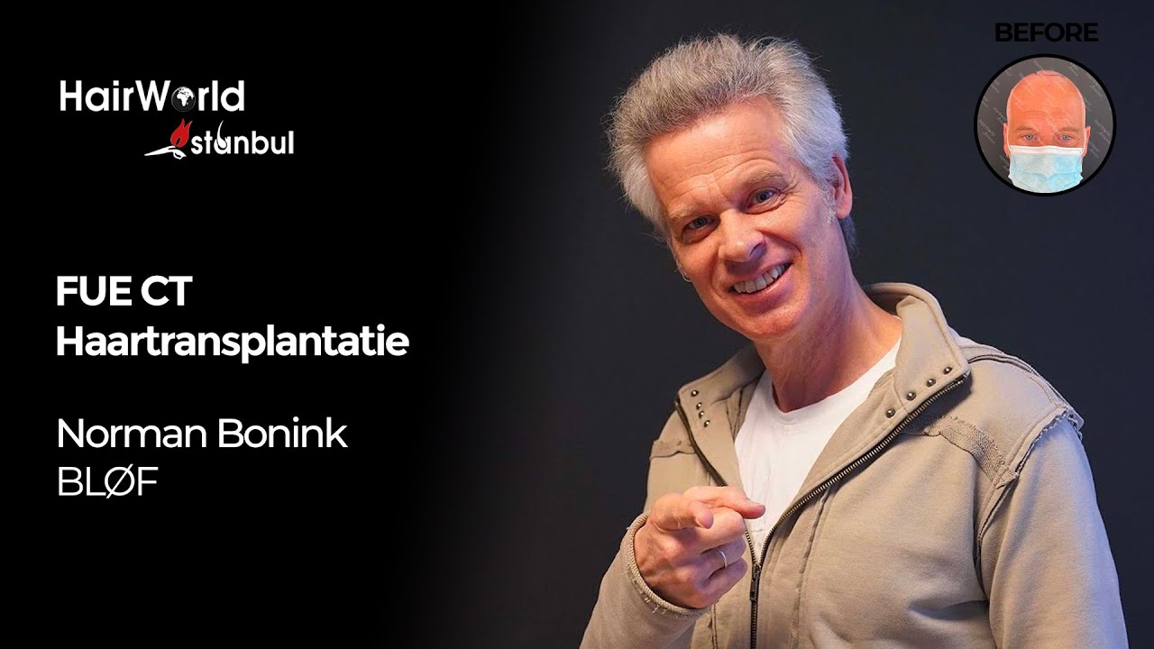 Cliëntervaring: de FUE CT haartransplantatie van Norman Bonink (BLØF)