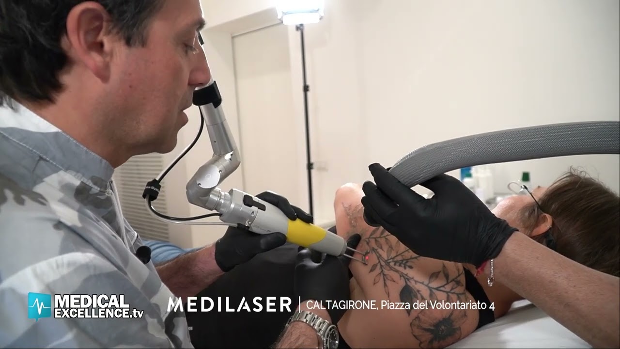 Rimozione tatuaggio con laser a picosecondi